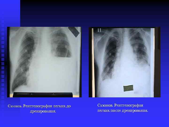 Сазонов. Рентгенография легких до дренирования. Сазонов. Рентгенография легких после дренирования. 