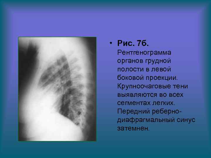  • Рис. 7 б. Рентгенограмма органов грудной полости в левой боковой проекции. Крупноочаговые