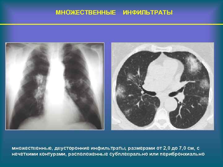 МНОЖЕСТВЕННЫЕ ИНФИЛЬТРАТЫ множественные, двусторонние инфильтраты, размерами от 2, 0 до 7, 0 см, с