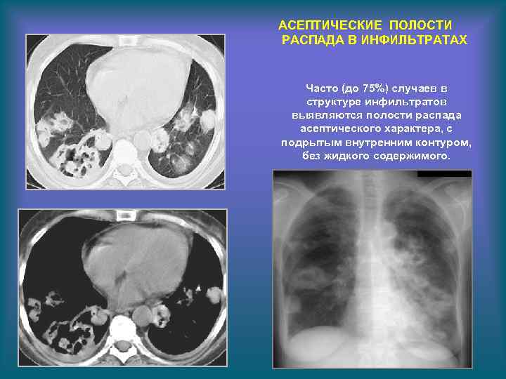 АСЕПТИЧЕСКИЕ ПОЛОСТИ РАСПАДА В ИНФИЛЬТРАТАХ Часто (до 75%) случаев в структуре инфильтратов выявляются полости