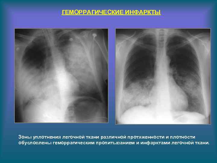 Уплотнение легочного рисунка в прикорневой зоне