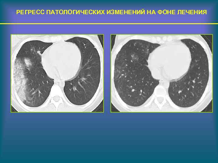 РЕГРЕСС ПАТОЛОГИЧЕСКИХ ИЗМЕНЕНИЙ НА ФОНЕ ЛЕЧЕНИЯ 