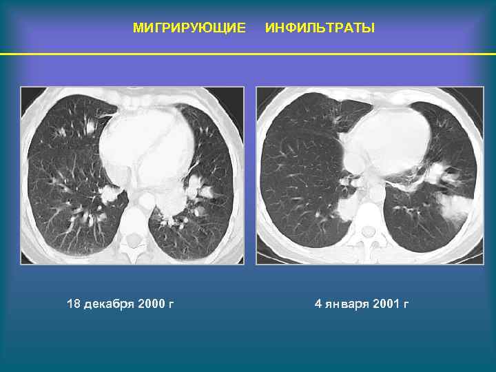 МИГРИРУЮЩИЕ 18 декабря 2000 г ИНФИЛЬТРАТЫ 4 января 2001 г 