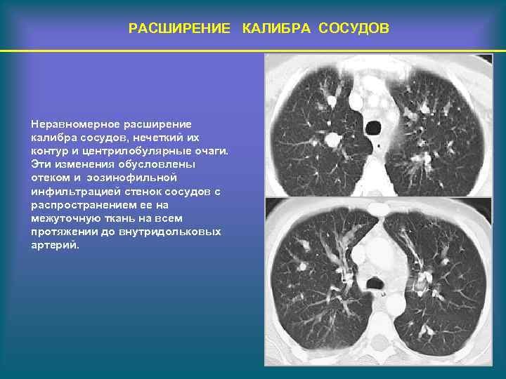 Расширение сосудов