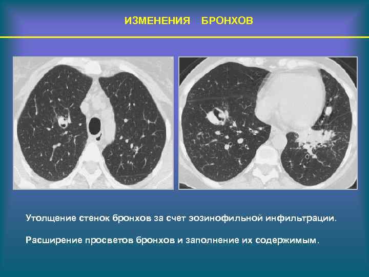 Стенки бронхов. Стенки бронхов уплотнены. Утолщение стенок бронхов. Стенки бронхов утолщены на кт. Утолщение стенок бронхов на кт.