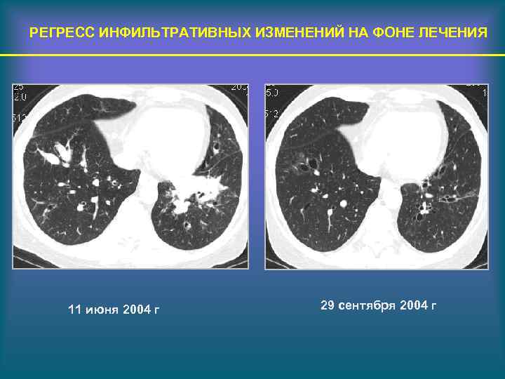 РЕГРЕСС ИНФИЛЬТРАТИВНЫХ ИЗМЕНЕНИЙ НА ФОНЕ ЛЕЧЕНИЯ 11 июня 2004 г 29 сентября 2004 г