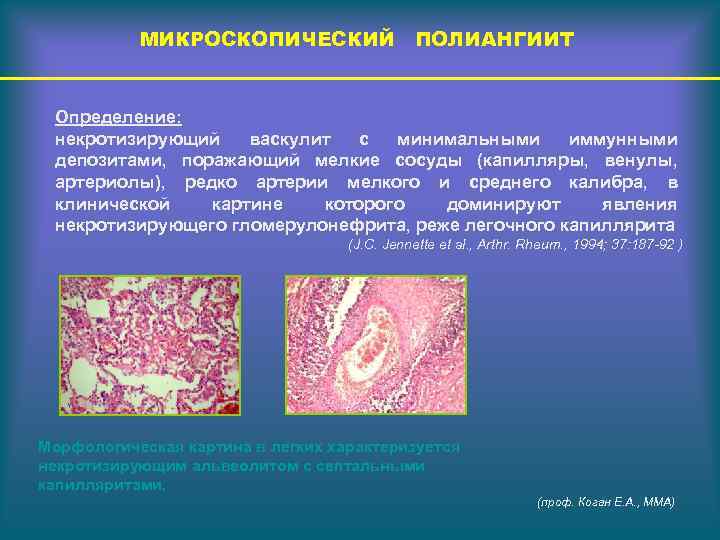 МИКРОСКОПИЧЕСКИЙ ПОЛИАНГИИТ Определение: некротизирующий васкулит с минимальными иммунными депозитами, поражающий мелкие сосуды (капилляры, венулы,