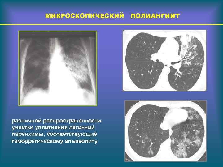 МИКРОСКОПИЧЕСКИЙ ПОЛИАНГИИТ различной распространенности участки уплотнения легочной паренхимы, соответствующие геморрагическому альвеолиту 