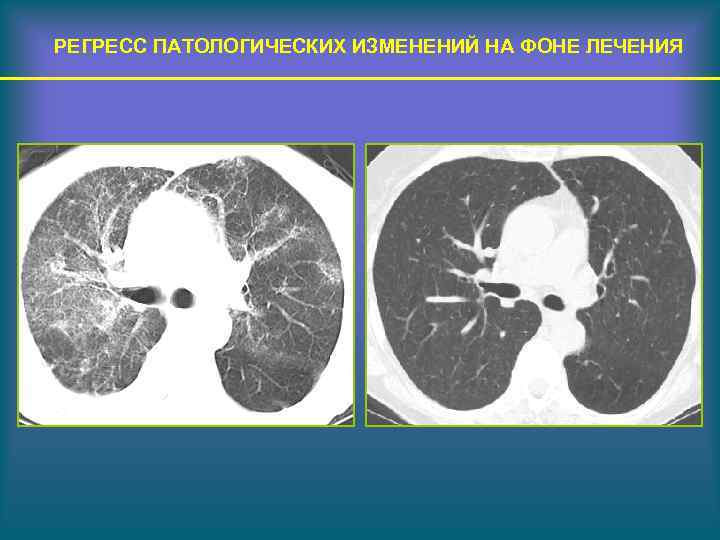 РЕГРЕСС ПАТОЛОГИЧЕСКИХ ИЗМЕНЕНИЙ НА ФОНЕ ЛЕЧЕНИЯ 