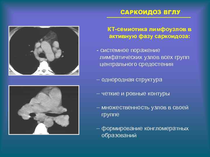 САРКОИДОЗ ВГЛУ КТ-семиотика лимфоузлов в активную фазу саркоидоза: - системное поражение лимфатических узлов всех