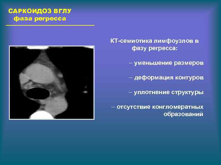 САРКОИДОЗ ВГЛУ фаза регресса КТ-семиотика лимфоузлов в фазу регресса: – уменьшение размеров – деформация