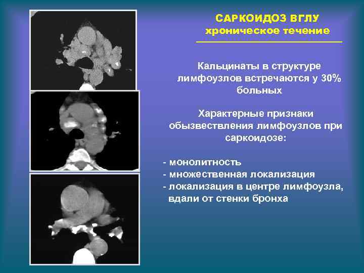 САРКОИДОЗ ВГЛУ хроническое течение Кальцинаты в структуре лимфоузлов встречаются у 30% больных Характерные признаки