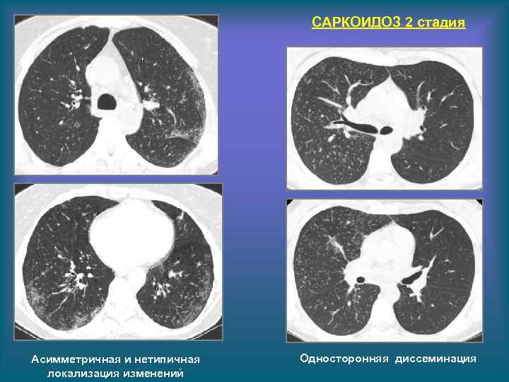 САРКОИДОЗ 2 стадия Асимметричная и нетипичная локализация изменений Односторонняя диссеминация 