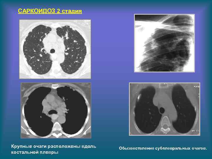Кт картина саркоидоза легких