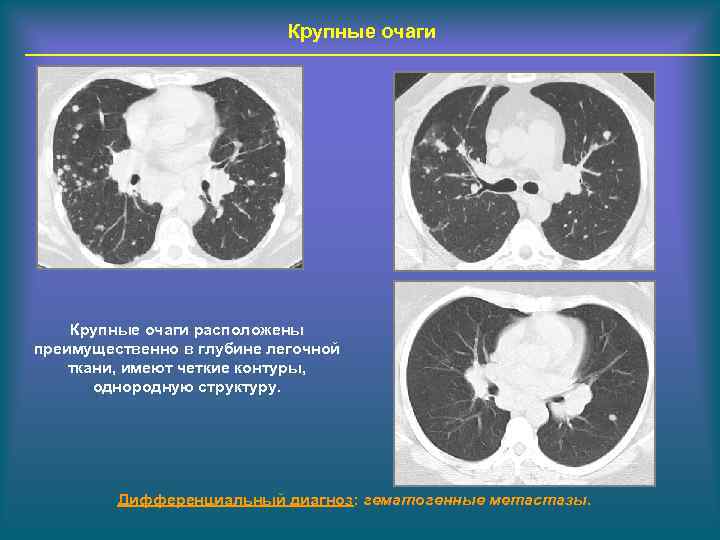 Очаги в легких с четкими контурами