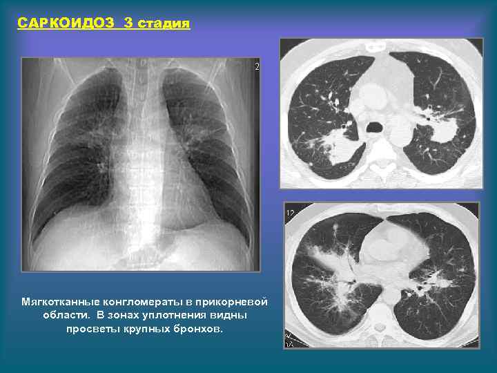 Конгломерат узлов. Саркоидоз легких 3 степени. Саркоидоз легких 3 стадия.