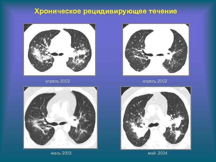 Хроническое рецидивирующее течение апрель 2002 июль 2003 апрель 2002 май 2004 