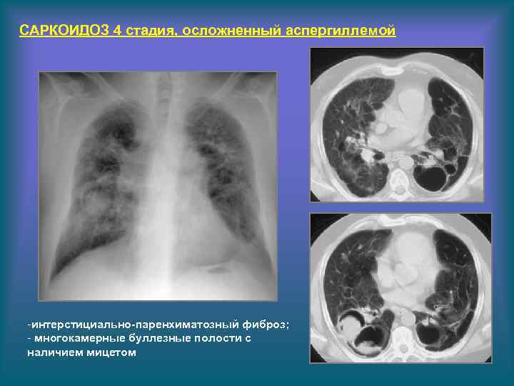 САРКОИДОЗ 4 стадия, осложненный аспергиллемой -интерстициально-паренхиматозный фиброз; - многокамерные буллезные полости с наличием мицетом