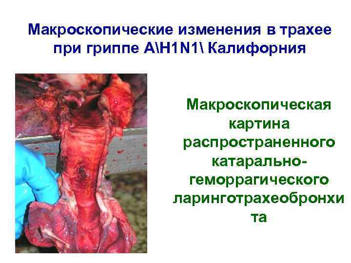 Макроскопические изменения в трахее при гриппе АH 1 N 1 Калифорния Макроскопическая картина распространенного