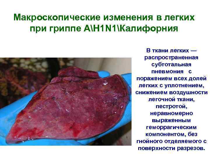 Макроскопические изменения в легких при гриппе АH 1 N 1Калифорния В ткани легких —