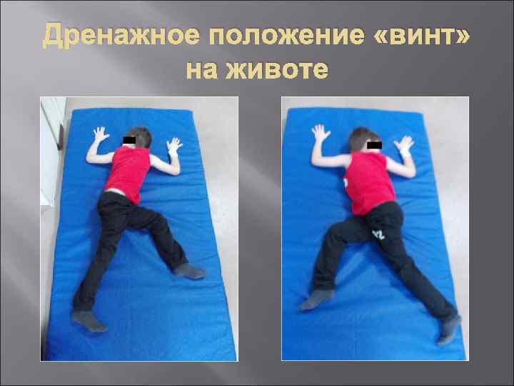 Дренажное положение «винт» на животе 