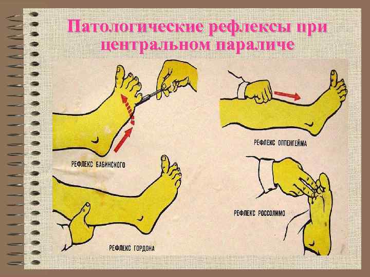 Патологические рефлексы при центральном параличе 