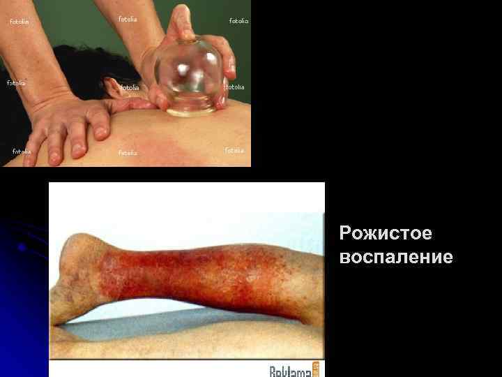 Рожистое воспаление 