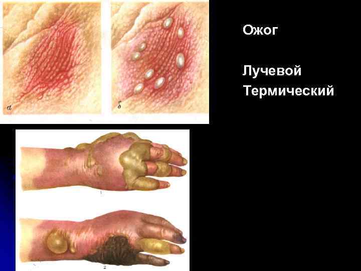 Ожог Лучевой Термический 