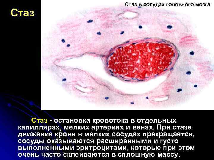 Стаз в сосудах головного мозга Стаз - остановка кровотока в отдельных капиллярах, мелких артериях