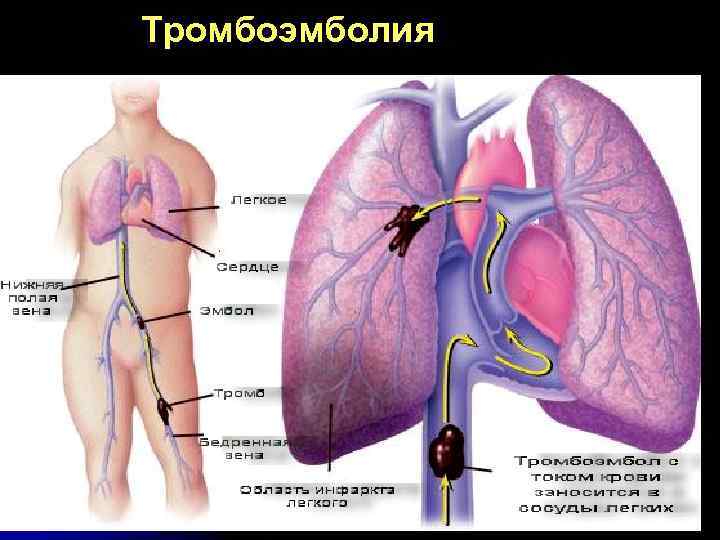 Тромбоэмболия 