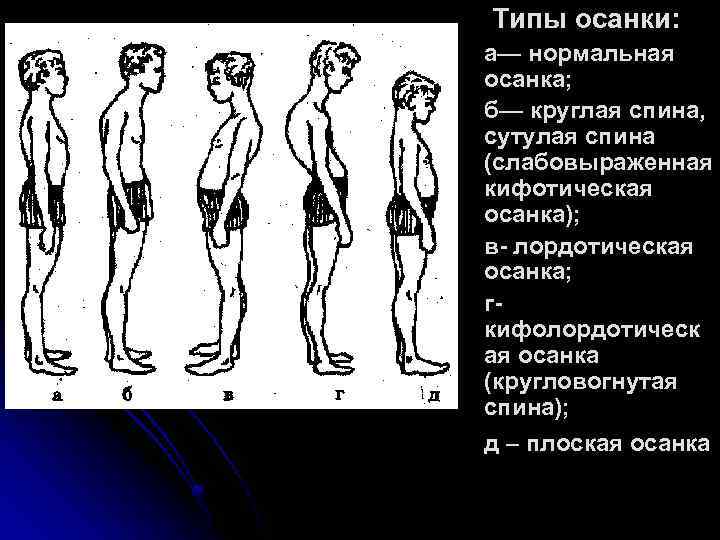 Типы осанки: а— нормальная осанка; б— круглая спина, сутулая спина (слабовыраженная кифотическая осанка); в-