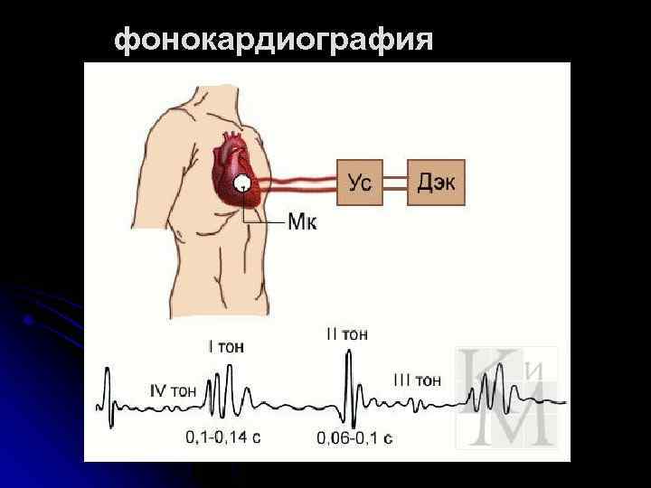 фонокардиография 