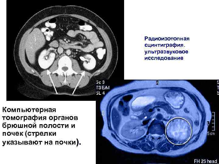 Радиоизотопная сцинтиграфия. ультразвуковое исследование Компьютерная томография органов брюшной полости и почек (стрелки указывают на