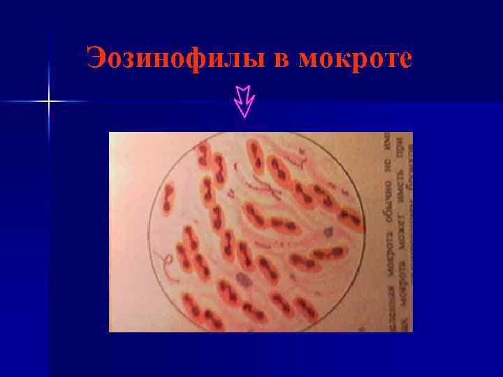 Эозинофилы в мокроте 