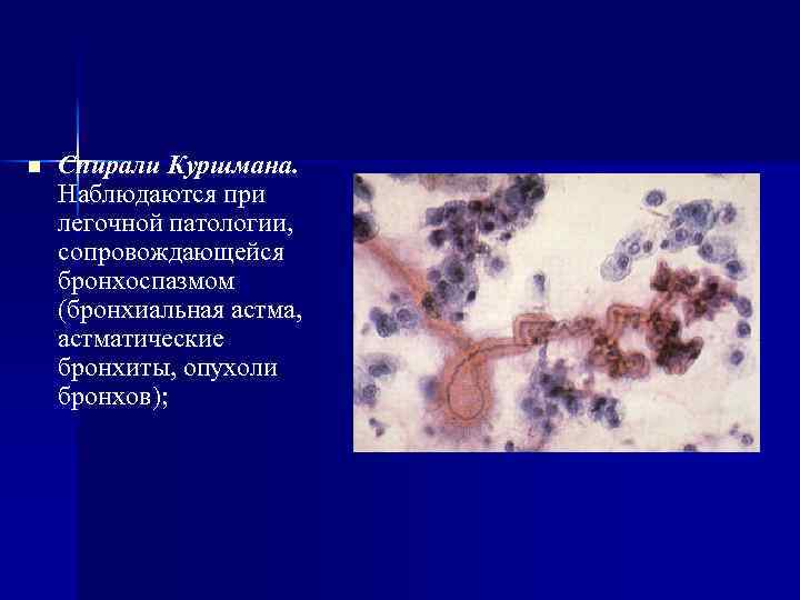 n Спирали Куршмана. Наблюдаются при легочной патологии, сопровождающейся бронхоспазмом (бронхиальная астма, астматические бронхиты, опухоли