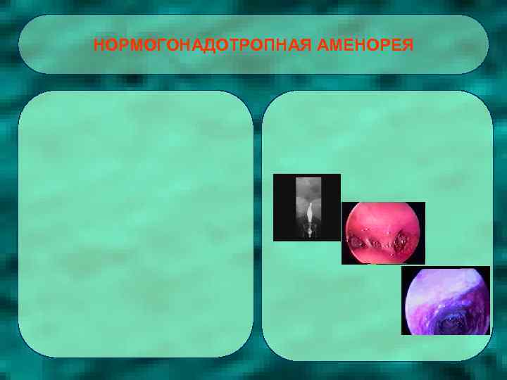 НОРМОГОНАДОТРОПНАЯ АМЕНОРЕЯ 