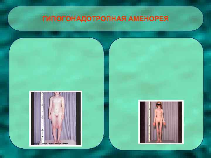 ГИПОГОНАДОТРОПНАЯ АМЕНОРЕЯ 