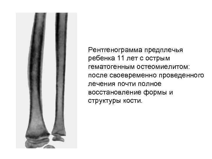 Рентгенограмма предплечья ребенка 11 лет с острым гематогенным остеомиелитом: после своевременно проведенного лечения почти