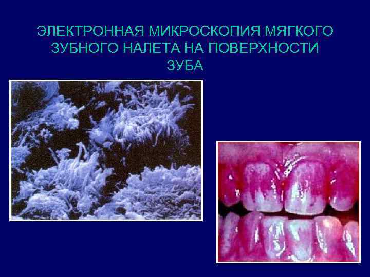 ЭЛЕКТРОННАЯ МИКРОСКОПИЯ МЯГКОГО ЗУБНОГО НАЛЕТА НА ПОВЕРХНОСТИ ЗУБА 