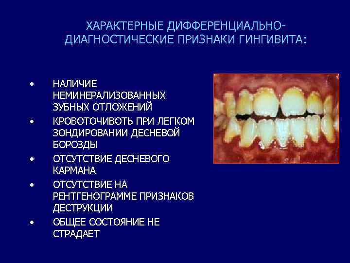 ХАРАКТЕРНЫЕ ДИФФЕРЕНЦИАЛЬНОДИАГНОСТИЧЕСКИЕ ПРИЗНАКИ ГИНГИВИТА: • • • НАЛИЧИЕ НЕМИНЕРАЛИЗОВАННЫХ ЗУБНЫХ ОТЛОЖЕНИЙ КРОВОТОЧИВОТЬ ПРИ ЛЕГКОМ
