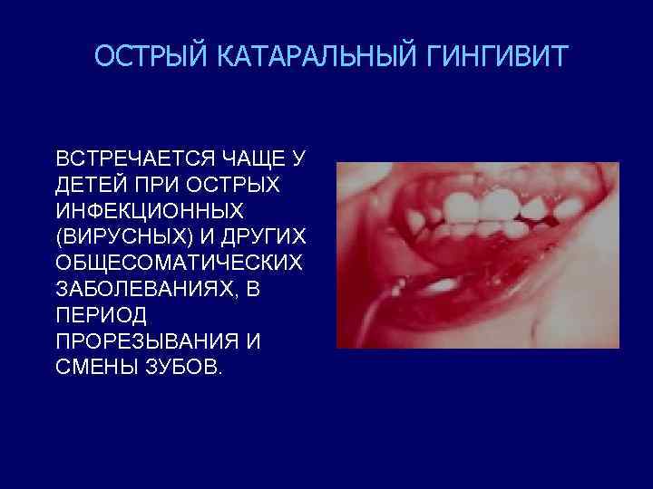 ОСТРЫЙ КАТАРАЛЬНЫЙ ГИНГИВИТ ВСТРЕЧАЕТСЯ ЧАЩЕ У ДЕТЕЙ ПРИ ОСТРЫХ ИНФЕКЦИОННЫХ (ВИРУСНЫХ) И ДРУГИХ ОБЩЕСОМАТИЧЕСКИХ