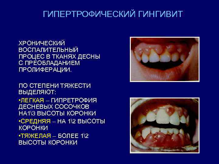 ГИПЕРТРОФИЧЕСКИЙ ГИНГИВИТ ХРОНИЧЕСКИЙ ВОСПАЛИТЕЛЬНЫЙ ПРОЦЕС В ТКАНЯХ ДЕСНЫ С ПРЕОБЛАДАНИЕМ ПРОЛИФЕРАЦИИ. ПО СТЕПЕНИ ТЯЖЕСТИ