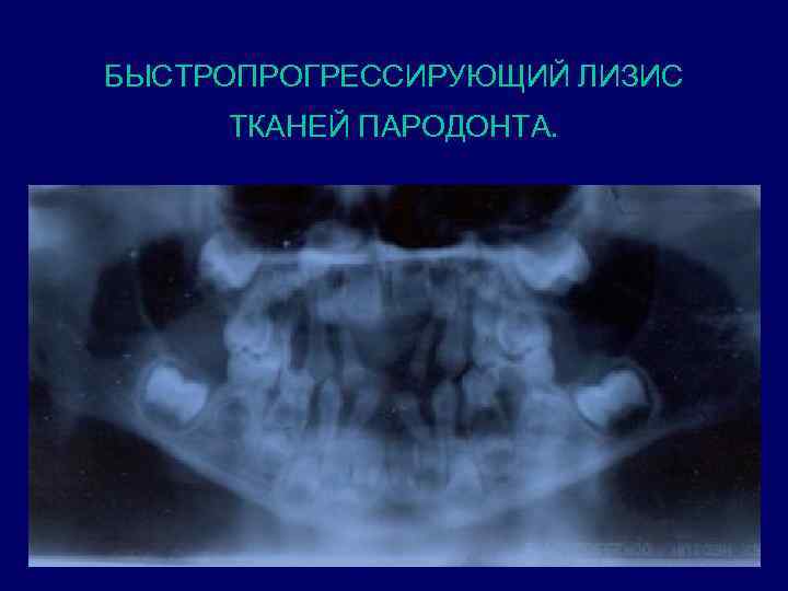 БЫСТРОПРОГРЕССИРУЮЩИЙ ЛИЗИС ТКАНЕЙ ПАРОДОНТА. 