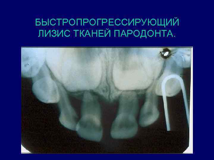 БЫСТРОПРОГРЕССИРУЮЩИЙ ЛИЗИС ТКАНЕЙ ПАРОДОНТА. 
