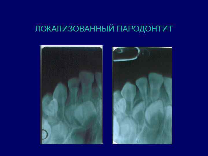 ЛОКАЛИЗОВАННЫЙ ПАРОДОНТИТ 