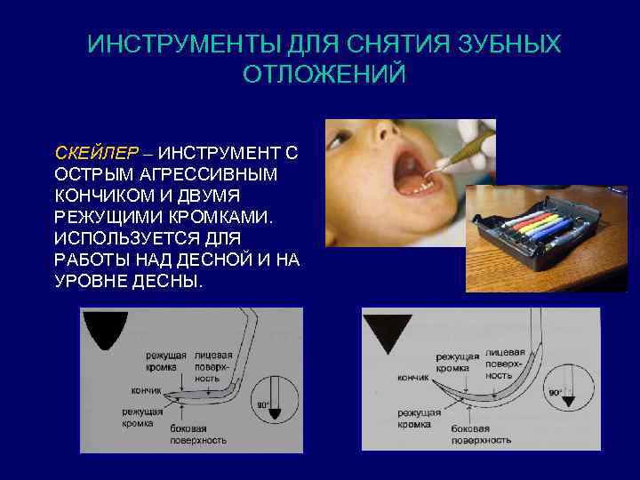 ИНСТРУМЕНТЫ ДЛЯ СНЯТИЯ ЗУБНЫХ ОТЛОЖЕНИЙ СКЕЙЛЕР – ИНСТРУМЕНТ С ОСТРЫМ АГРЕССИВНЫМ КОНЧИКОМ И ДВУМЯ