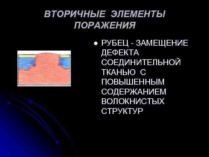 ВТОРИЧНЫЕ ЭЛЕМЕНТЫ ПОРАЖЕНИЯ l РУБЕЦ - ЗАМЕЩЕНИЕ ДЕФЕКТА СОЕДИНИТЕЛЬНОЙ ТКАНЬЮ С ПОВЫШЕННЫМ СОДЕРЖАНИЕМ ВОЛОКНИСТЫХ