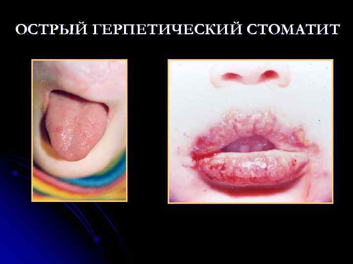 ОСТРЫЙ ГЕРПЕТИЧЕСКИЙ СТОМАТИТ 