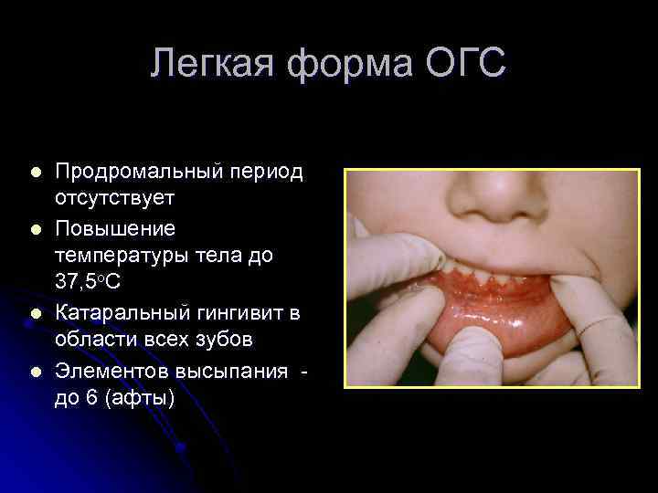 Легкая форма ОГС l l Продромальный период отсутствует Повышение температуры тела до 37, 5