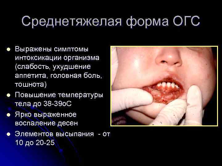 Среднетяжелая форма ОГС l l Выражены симптомы интоксикации организма (слабость, ухудшение аппетита, головная боль,